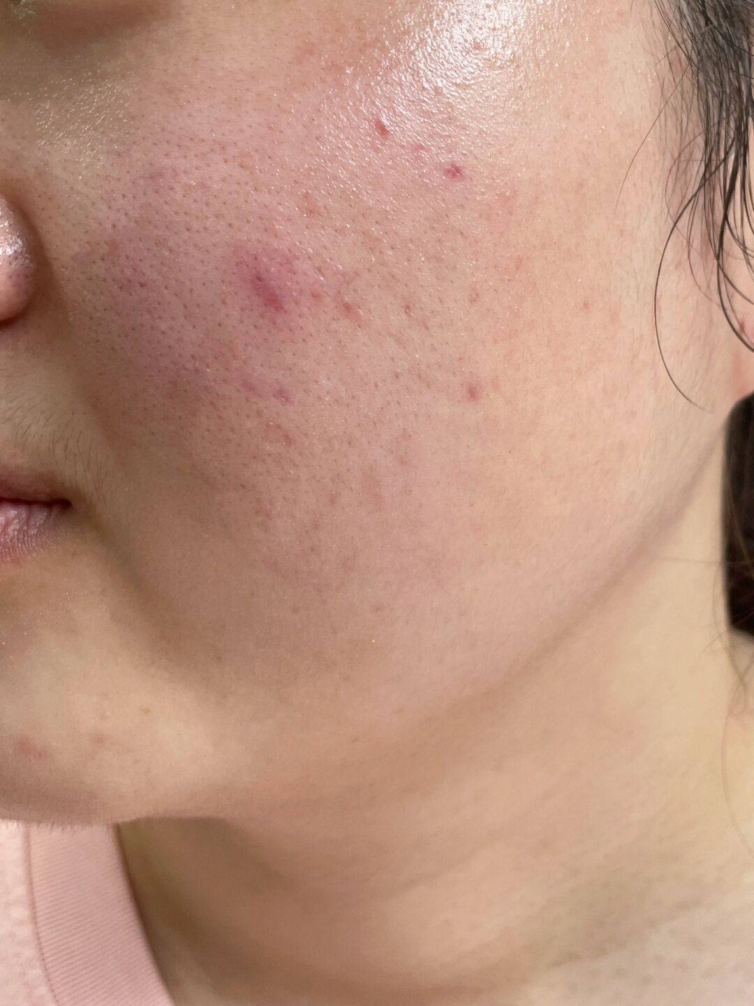 用了大脸过敏图片真实照片脸上过敏图片面部过敏过敏图片脸部辽上