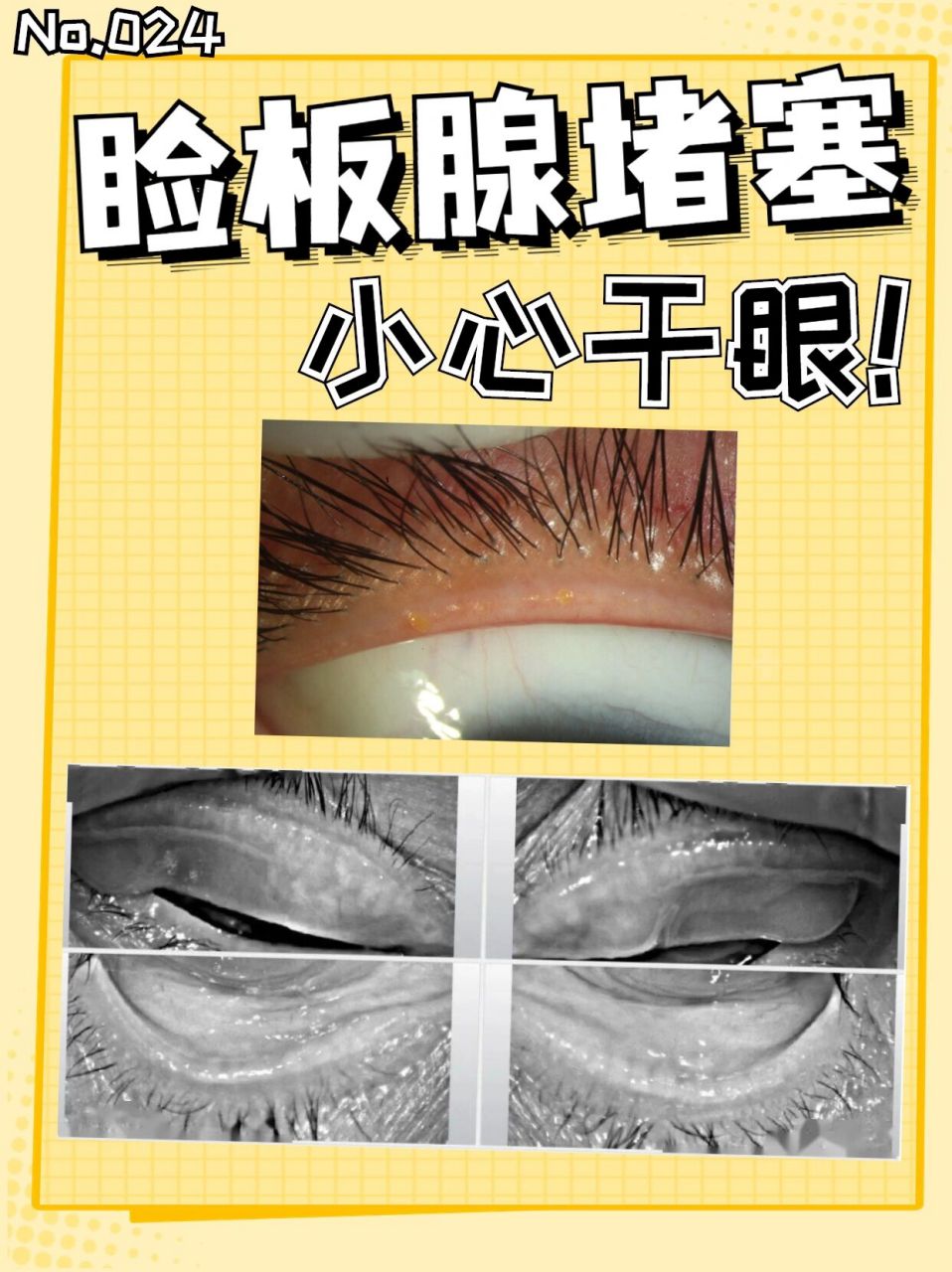 睑板腺堵塞,小心干眼!