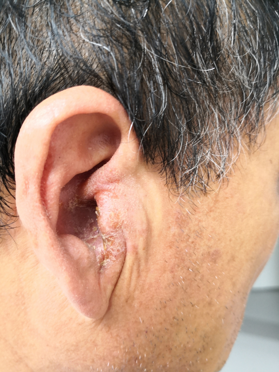 双侧耳廓外耳道肿胀瘙痒脱屑渗液症状.诊断湿疹.