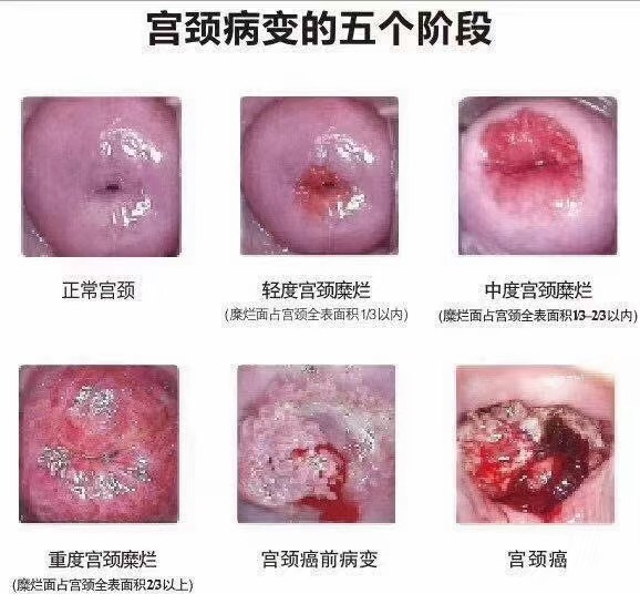 是免手术,让你的颈宫完整如 宫颈糜烂是什么原因造成的女人宫颈炎图片