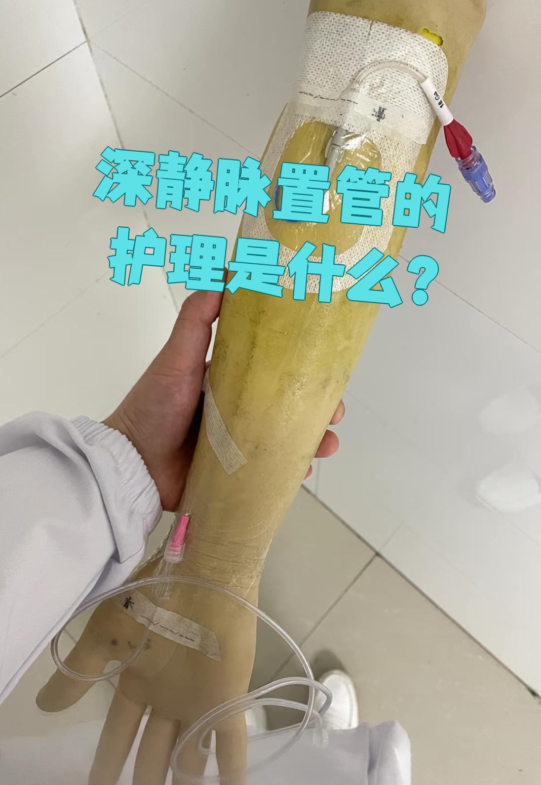 深静脉置管是通过深静脉穿刺置管术完成的,主要用于危重患者抢救