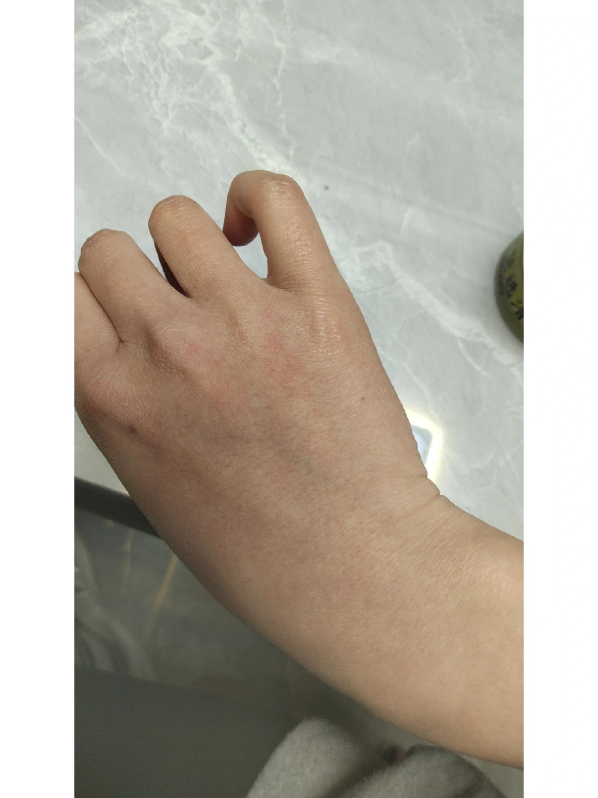 昨天配了针水可能是沾了点在手背上,洗手的时候就感觉"刺痛了"泛红了