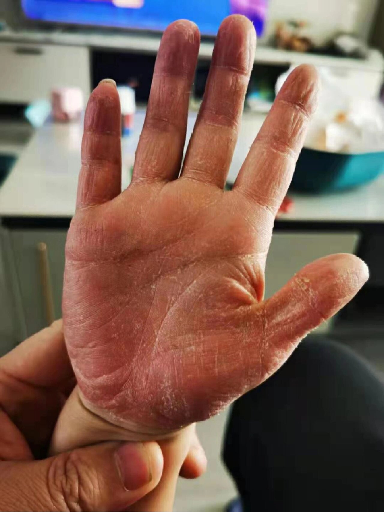 掌跖角化症是一组以掌跖皮肤增厚,角化过度为特征的一组慢性皮凡