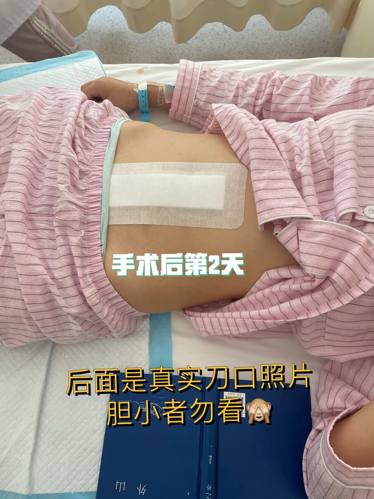 子宫肌瘤开腹手术9厘米刀口恢复