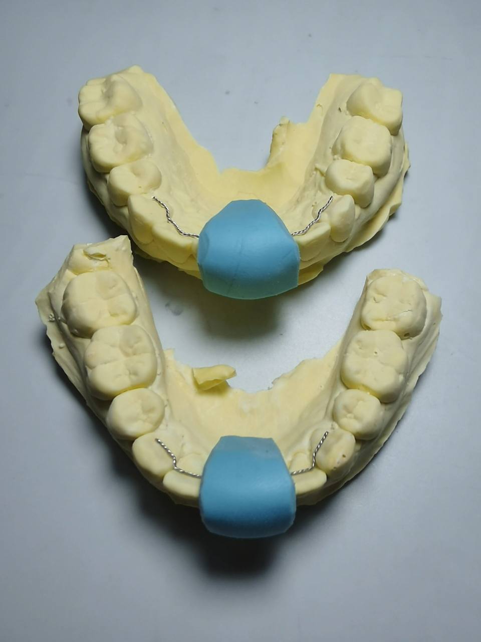 三种常规保持器的优缺点 介绍哈雷保持器/透明保持器/舌侧固定保持器