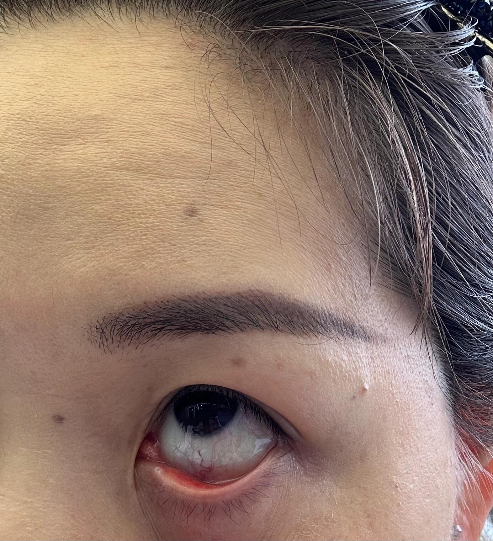 眼角膜划破,眼膜缺少一块