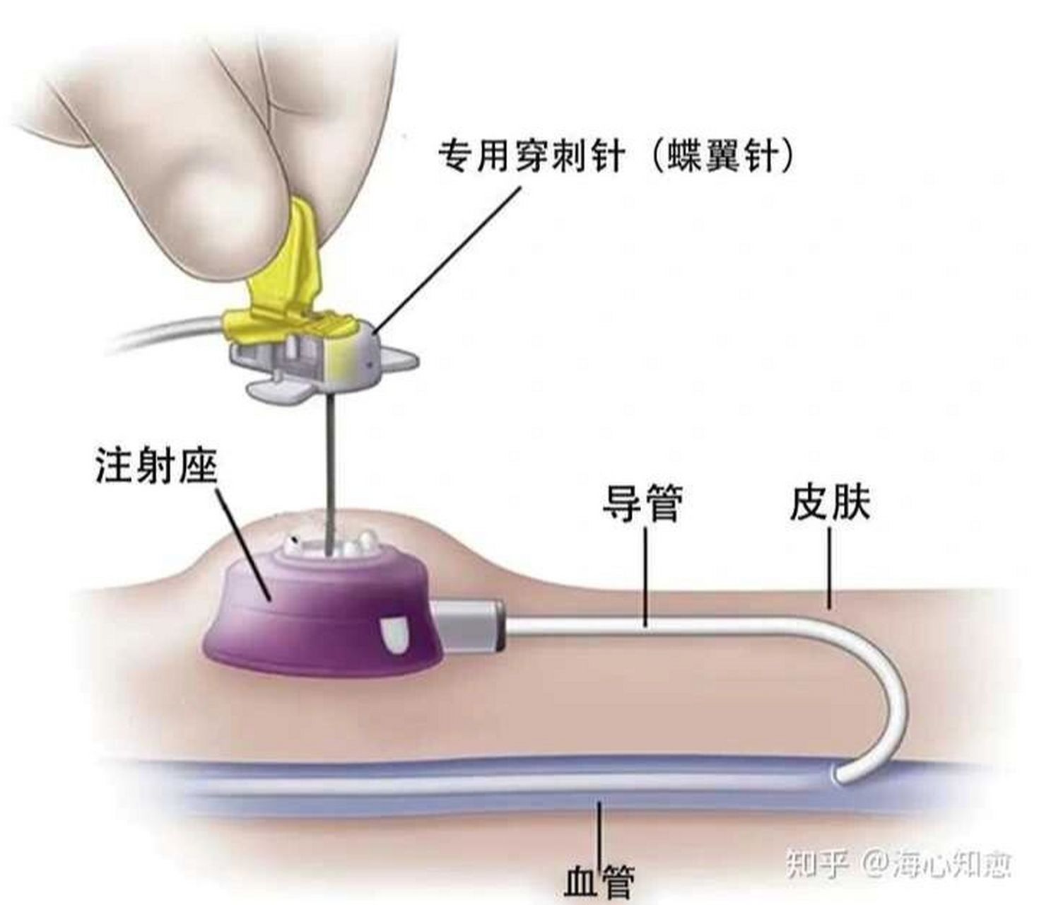 输液港连接针头图片