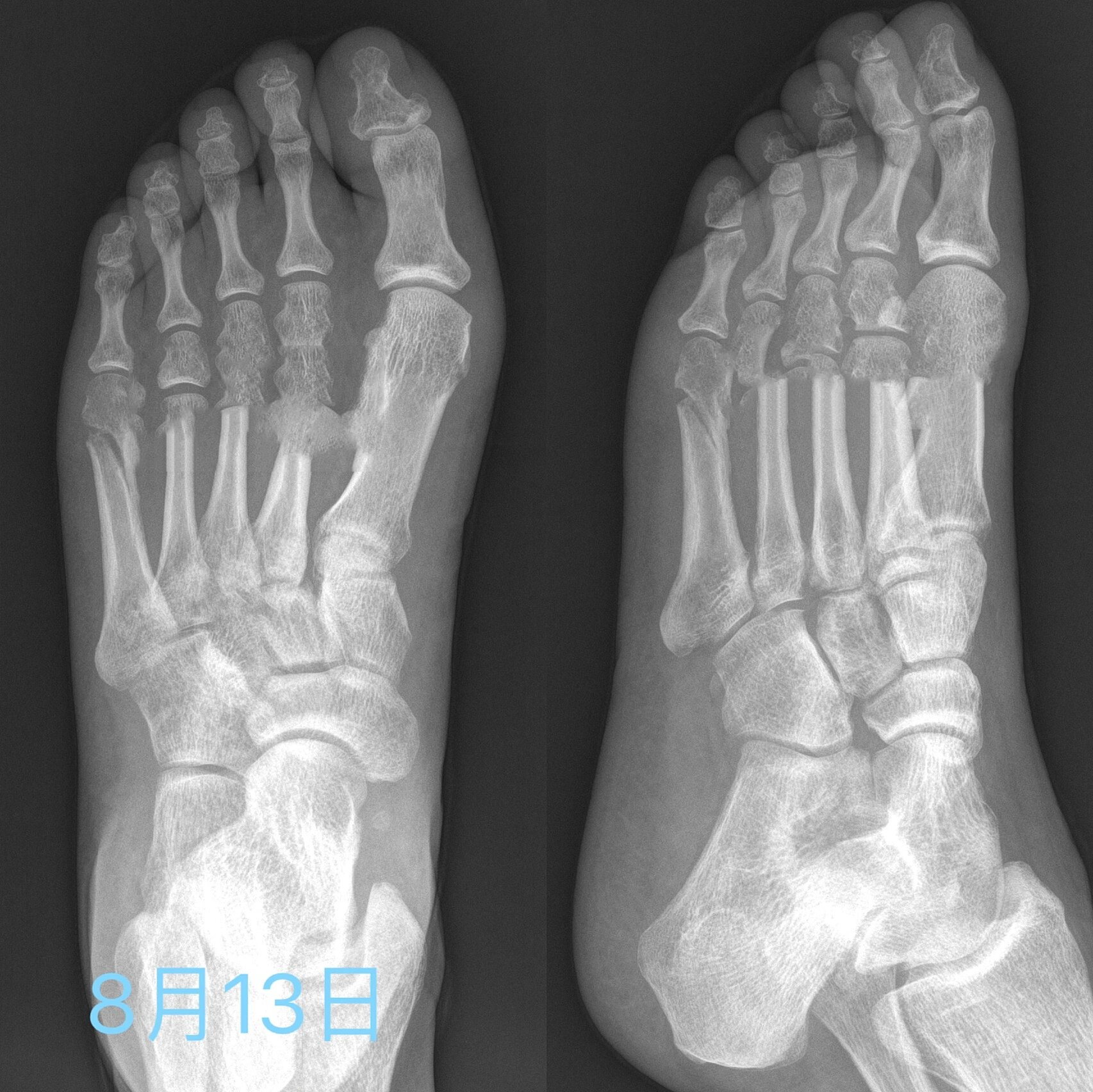 第五跖骨骨折四个多月 之前两个多月一直不长,心态崩了,后来去做了