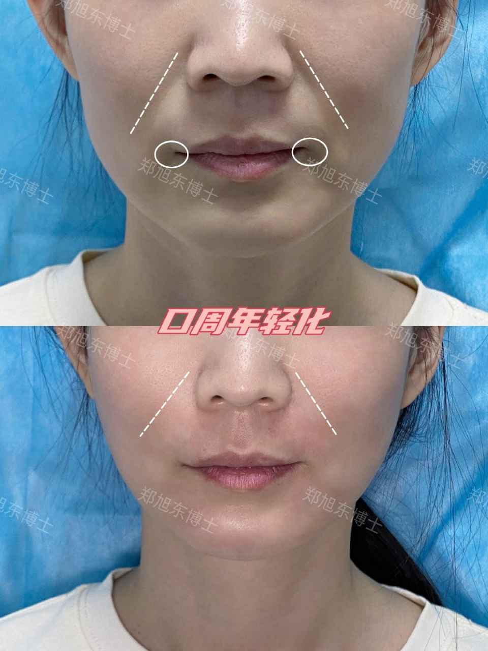 73口周年轻化73  嘴唇干瘪变薄,周围出现凹陷,缺乏精致感,连接