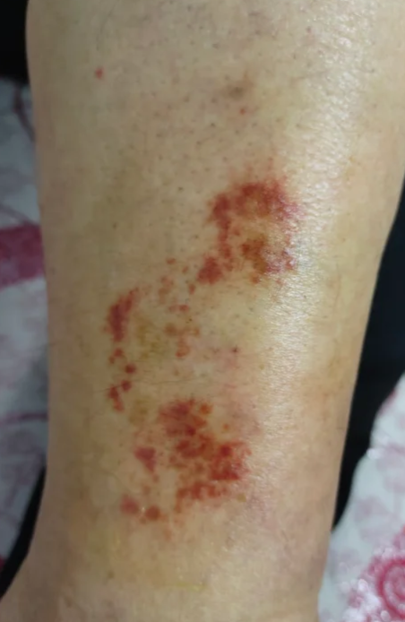 如对某些食物,药物或其他物质过敏,可能导致皮肤出现小红点状出血