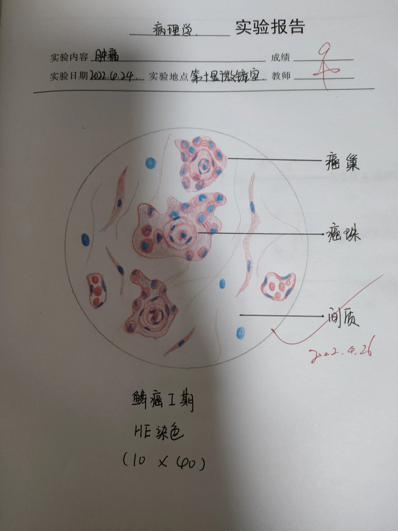 鳞癌Ⅰ期 风湿性心肌炎红蓝铅笔手绘图