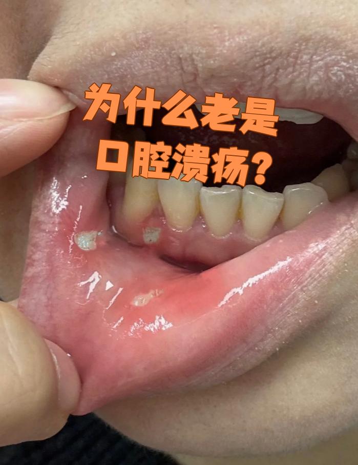 口腔为什么长溃疡百科在线