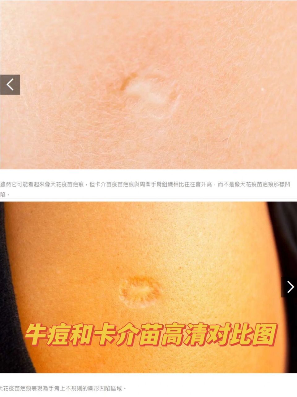 牛痘和卡介苗对比,免疫力在人体内存在多久 牛痘和卡介 的高清对比图