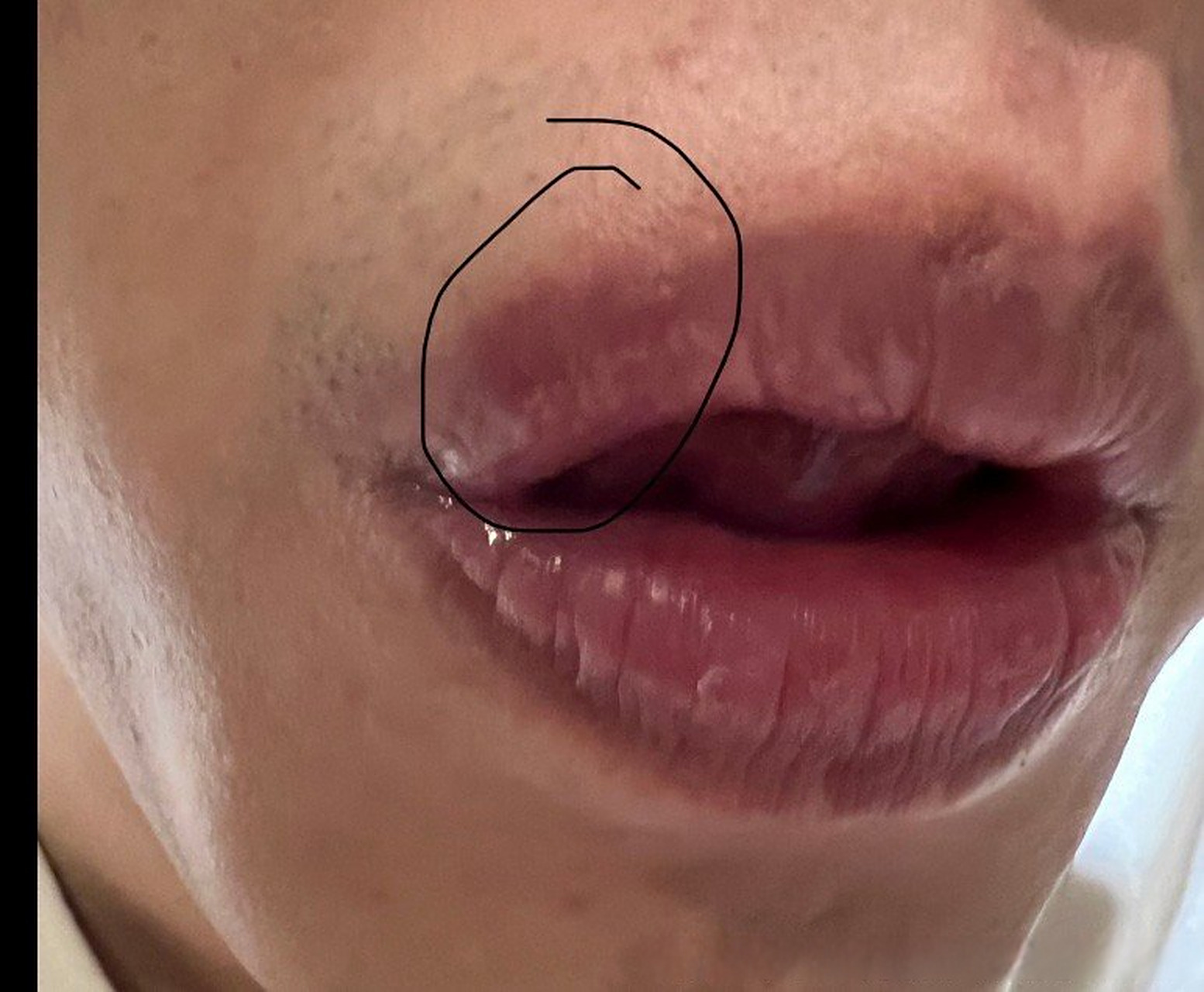 您好高大夫,之前多次咨询您的嘴唇这里口唇疱疹,你看照片,现在是不是