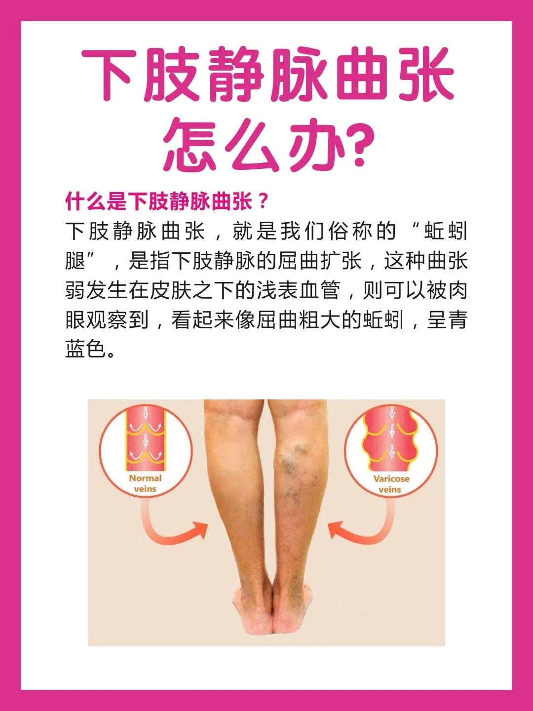 静脉曲张干货!下肢静脉曲张怎么办?