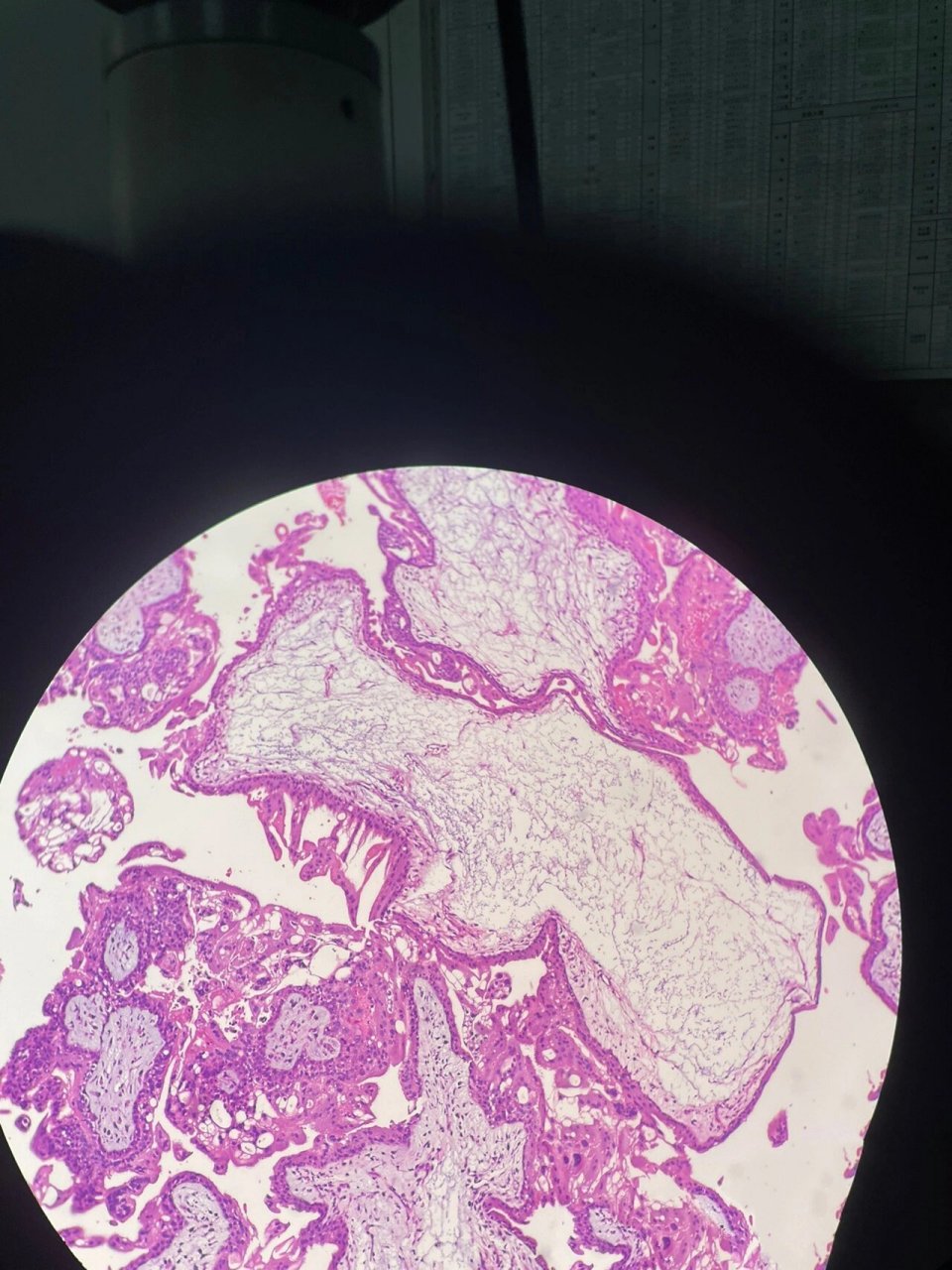 葡萄胎 1-3不完全性葡萄胎 4,5完全性葡萄胎 6正常绒毛