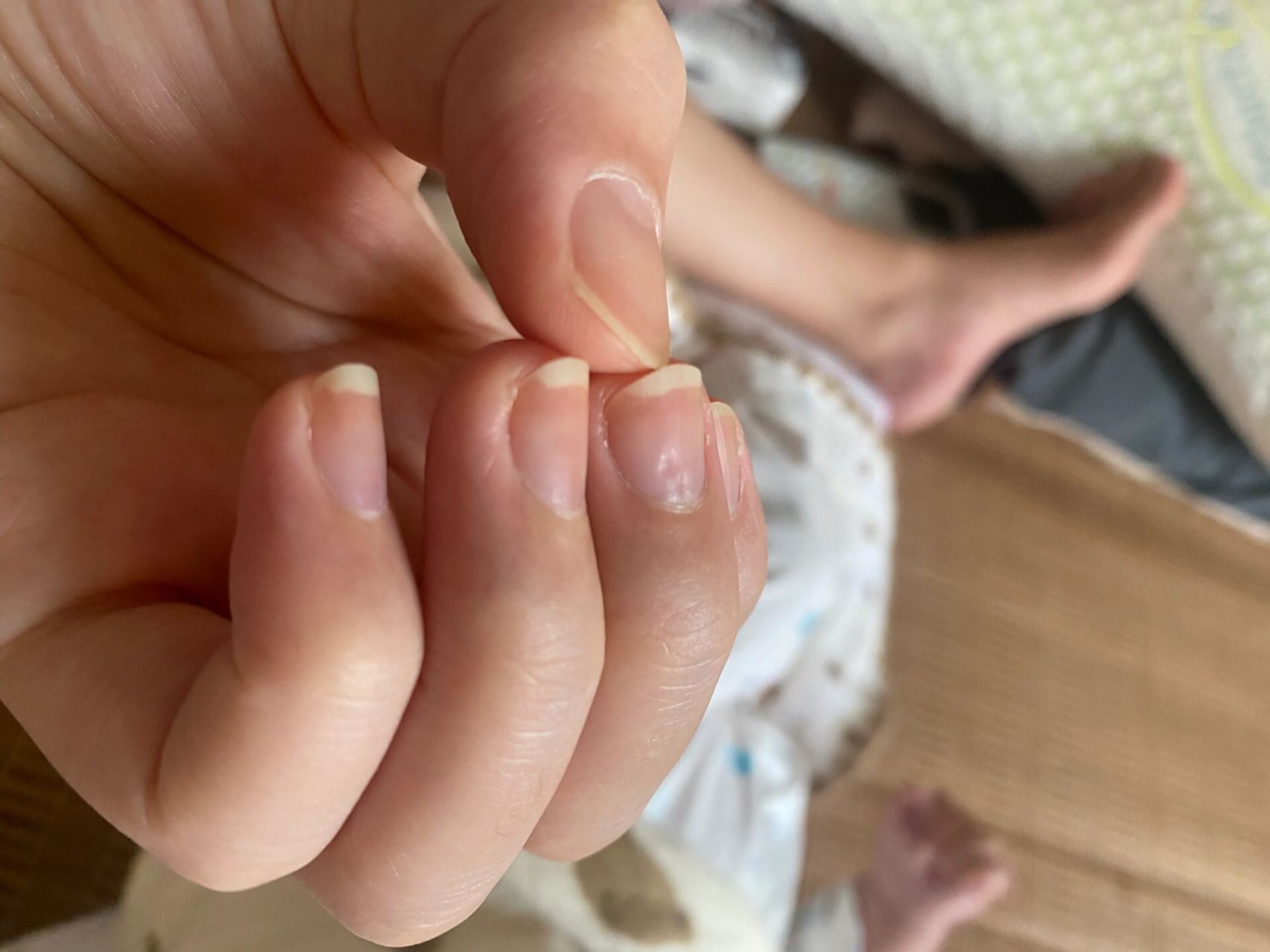 产后两个多月突然指甲变得凹凸不平 轻度抑郁症,最近感觉有点加重