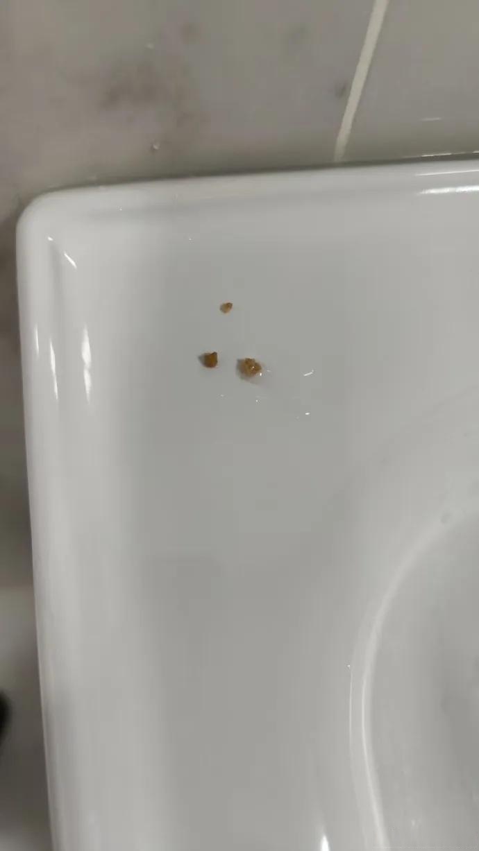 7尿结石排出来的图片射出来淡黄条形胶状物小便尿出结石图片结石排