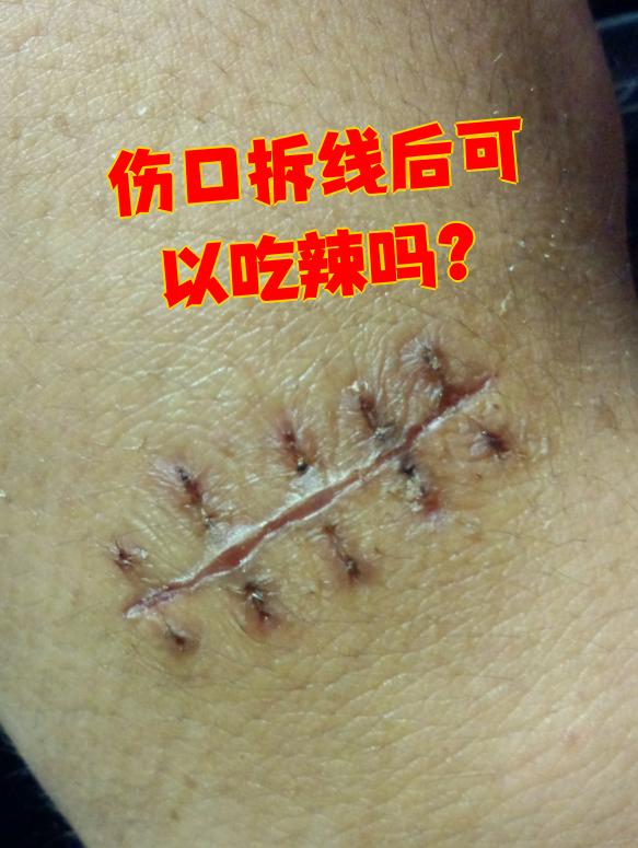 拆线后最好别吃辣,这对伤口恢复不好