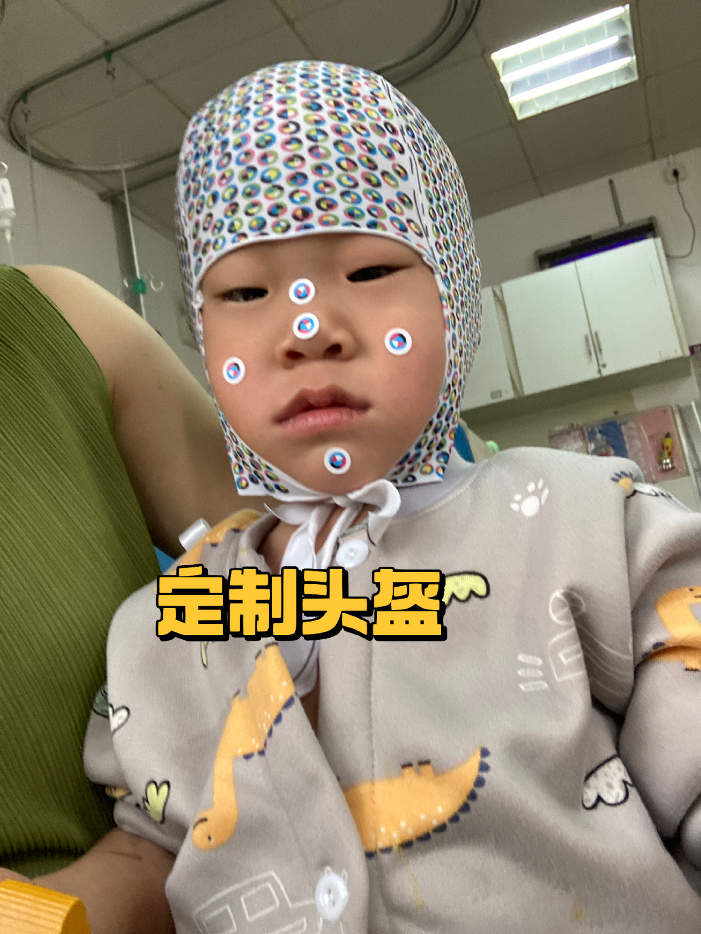 早闭头型矫正手术结束,效果不错    宝宝在儿童医院通过各种评估之后
