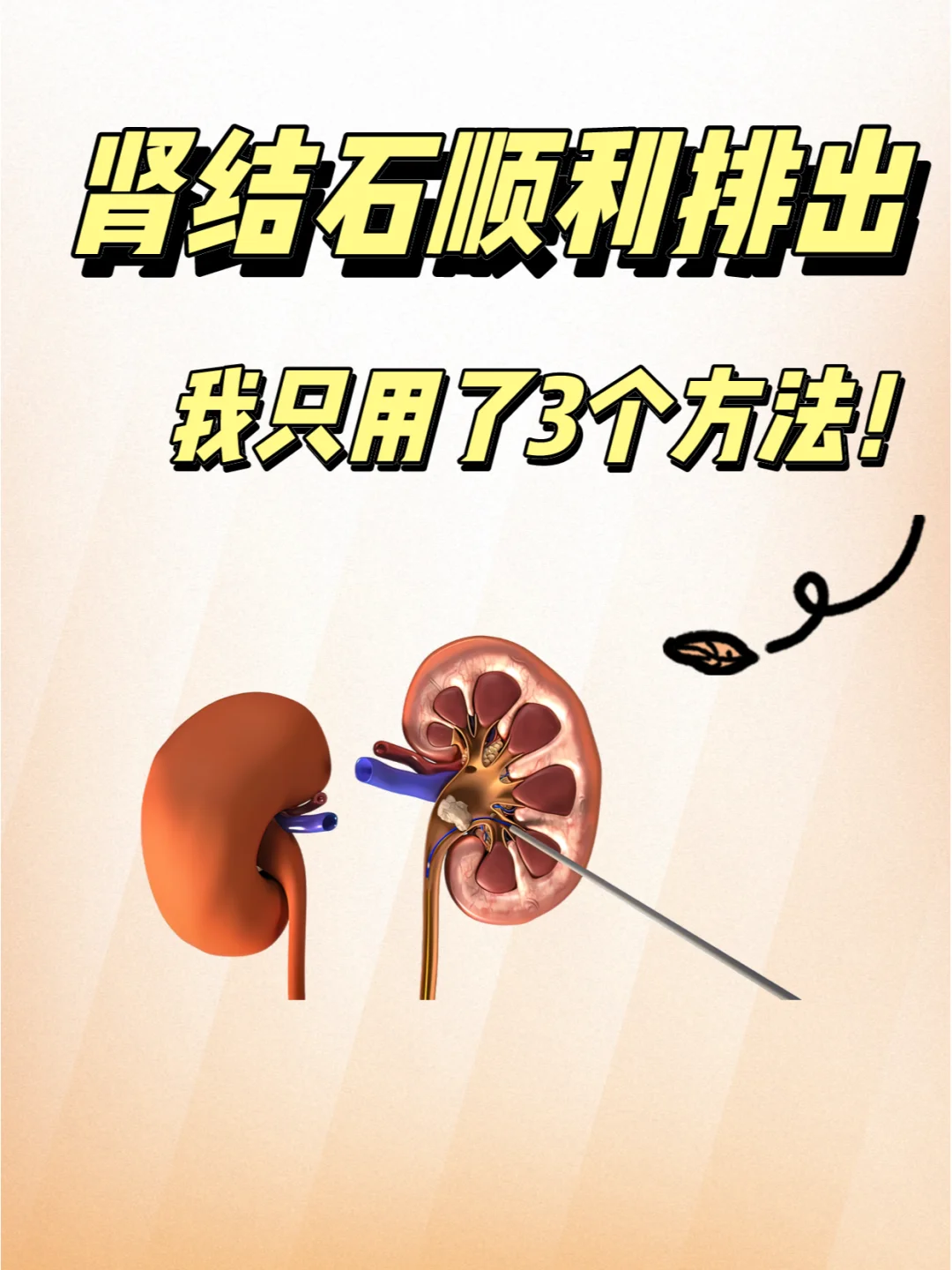 肾结石顺利排出!仅仅用了3个方法!💪✨