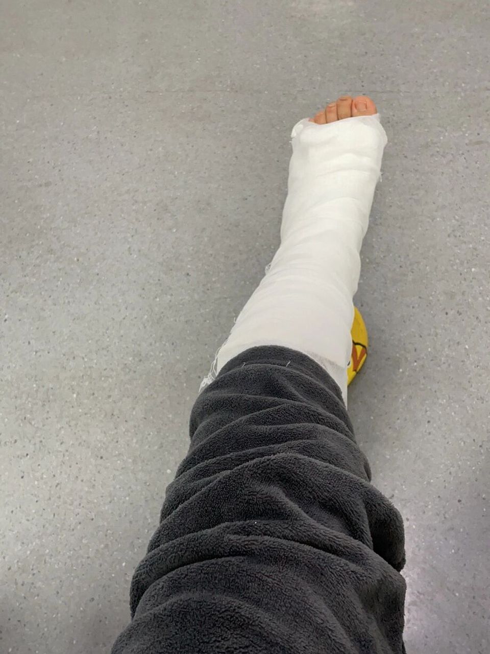 第五跖骨基底部骨折25天,石膏第19天 最近几天脚疼的厉害,今天去复查