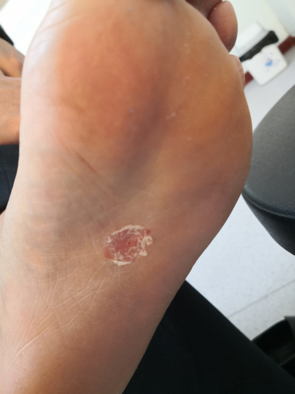 可以化验一下真菌确定诊断.#脚气##足癣