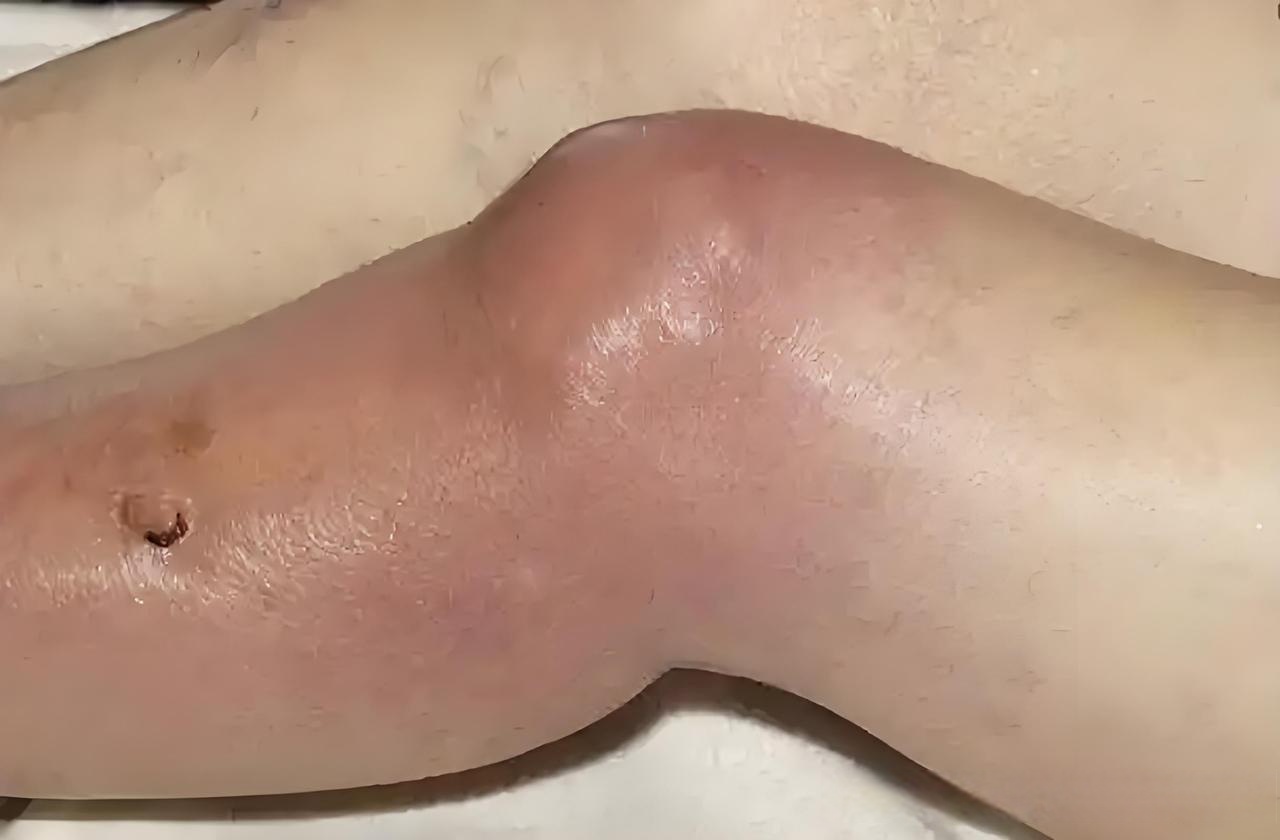 按这里5分钟,比秋水仙碱快2倍