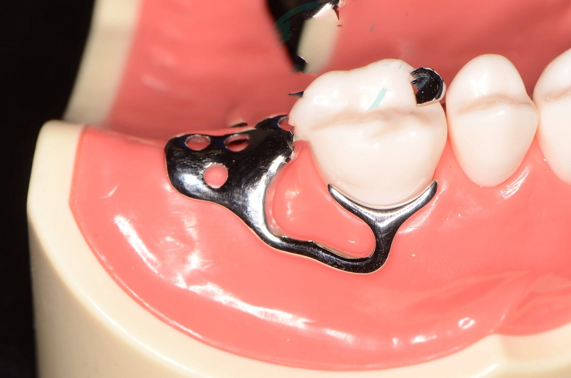 合支托预备和各种卡环 牙合支托凹的制备 制备原则 一般制备在缺隙