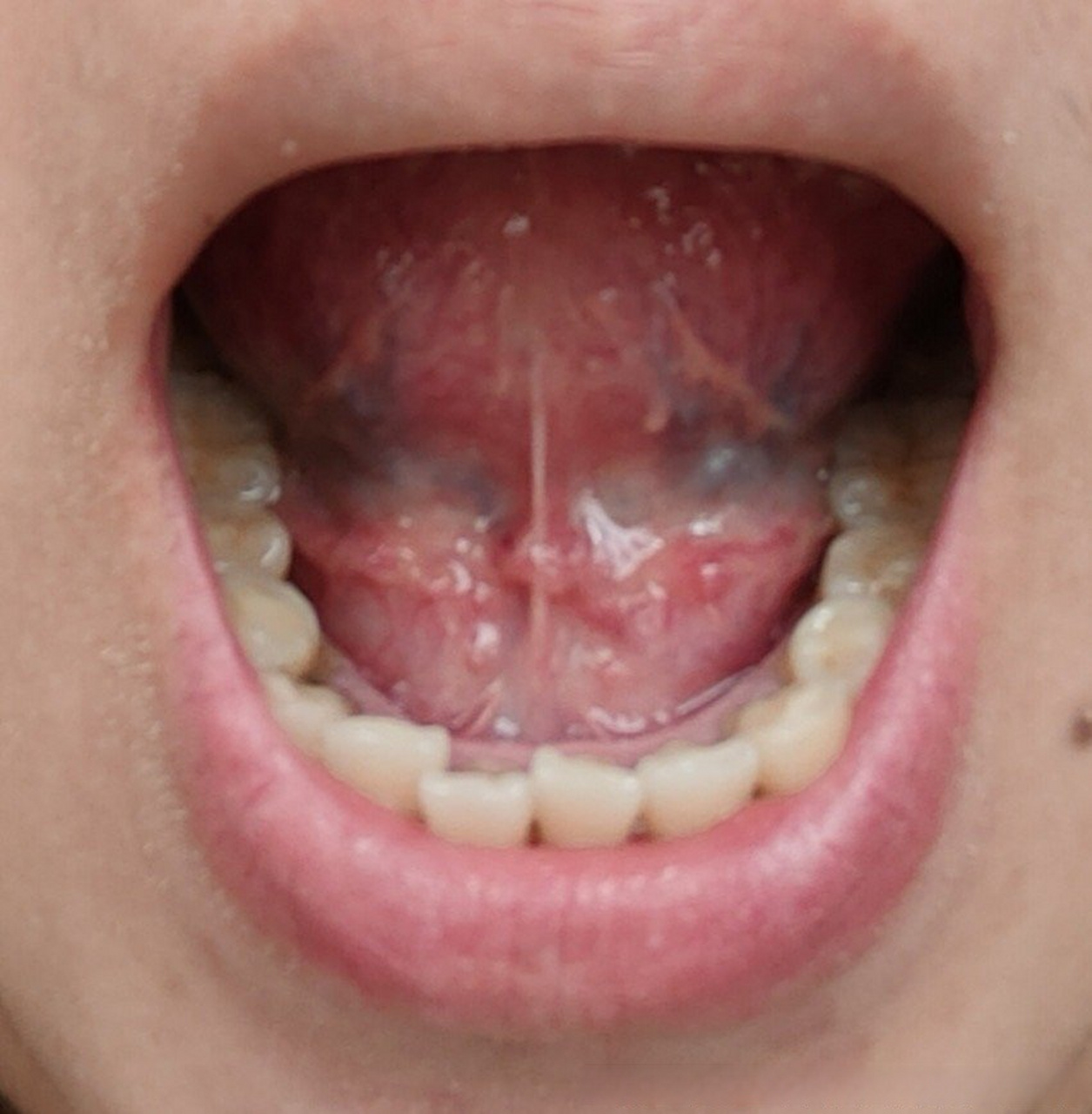 舌头系带两侧疙瘩图图片