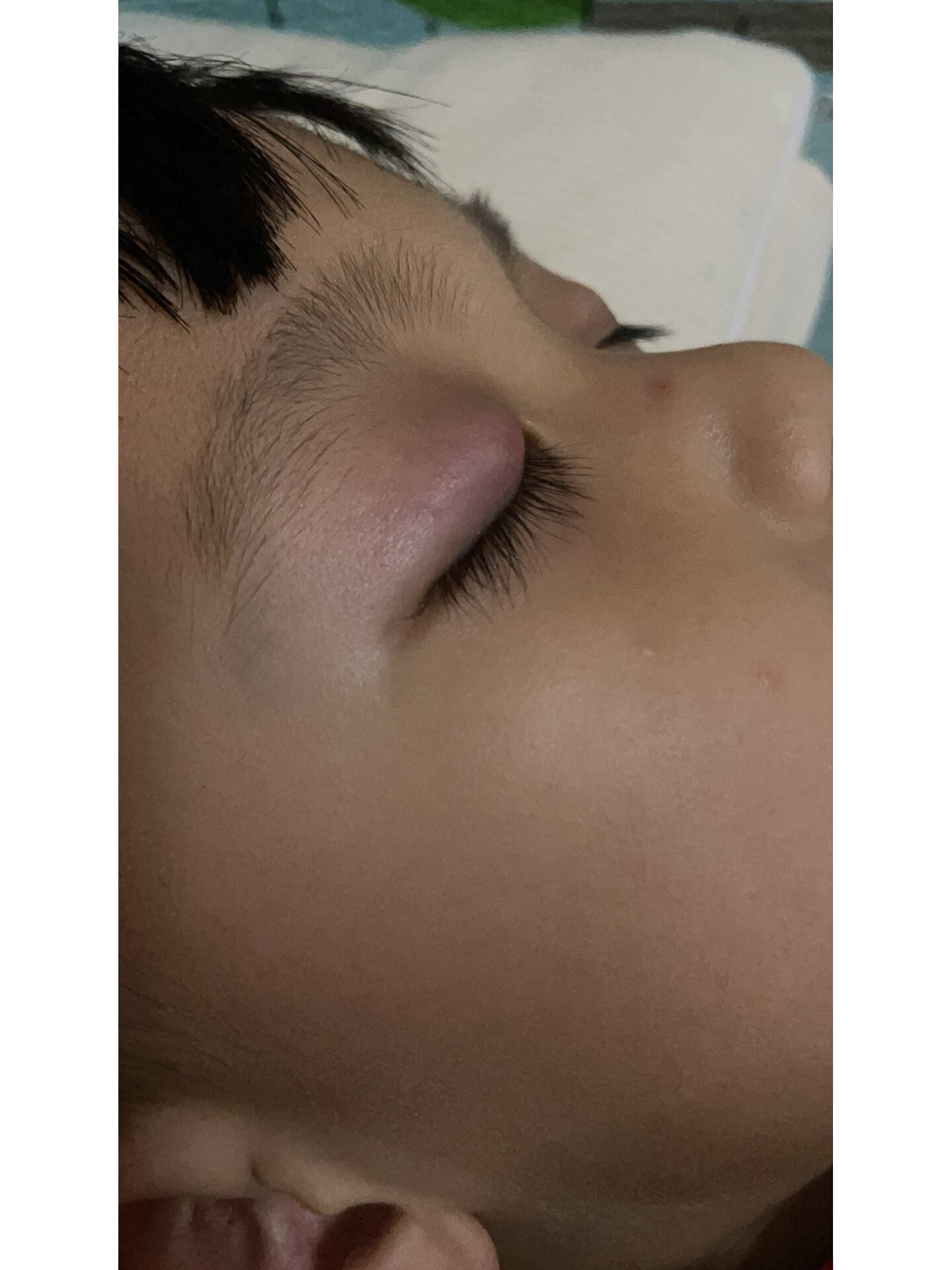 三岁八个月的宝宝得了霰粒肿 # 9月上幼儿园后 孩子有点上火,发现眼睛