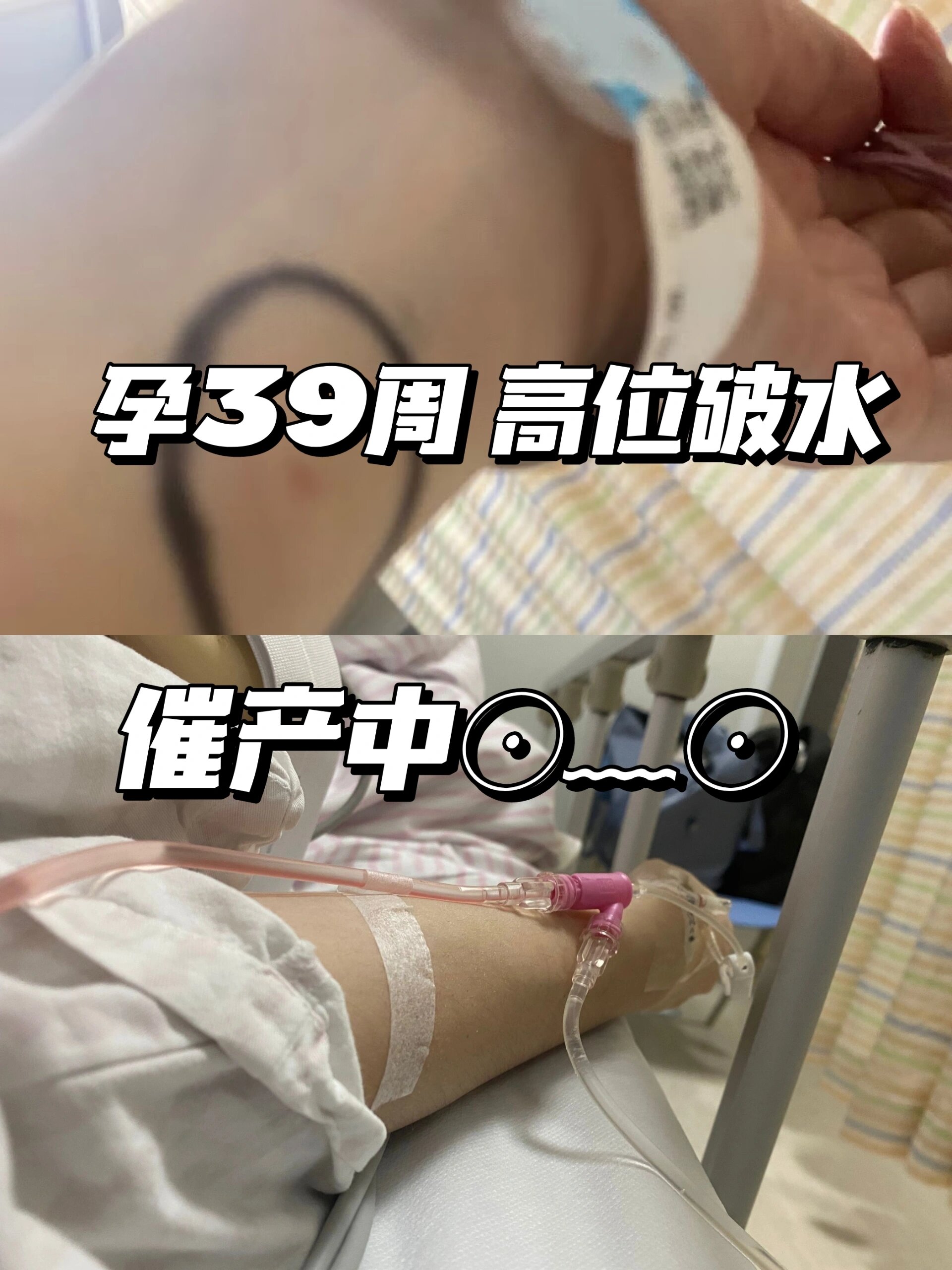 孕39周高位破水 住院催产ing