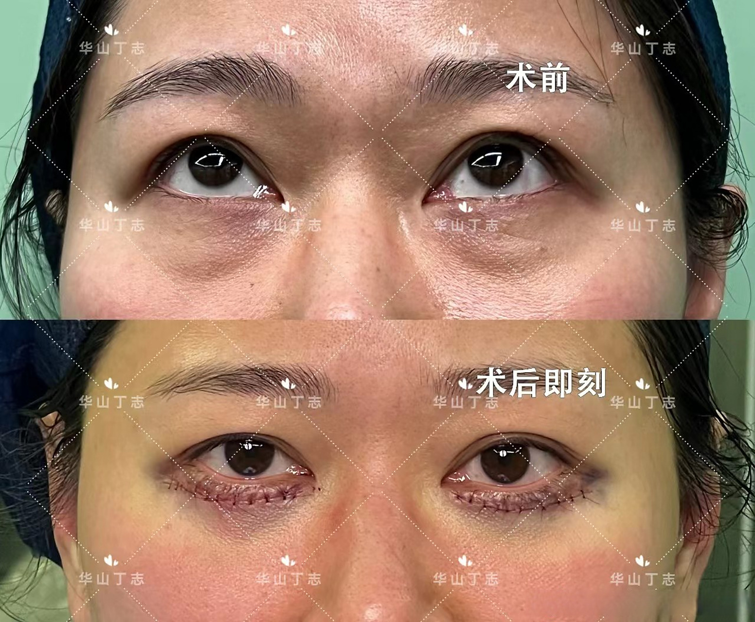 通过外切眼袋 眶隔释放解决眼袋和泪沟问题,术后即刻泪沟填平了,眼袋