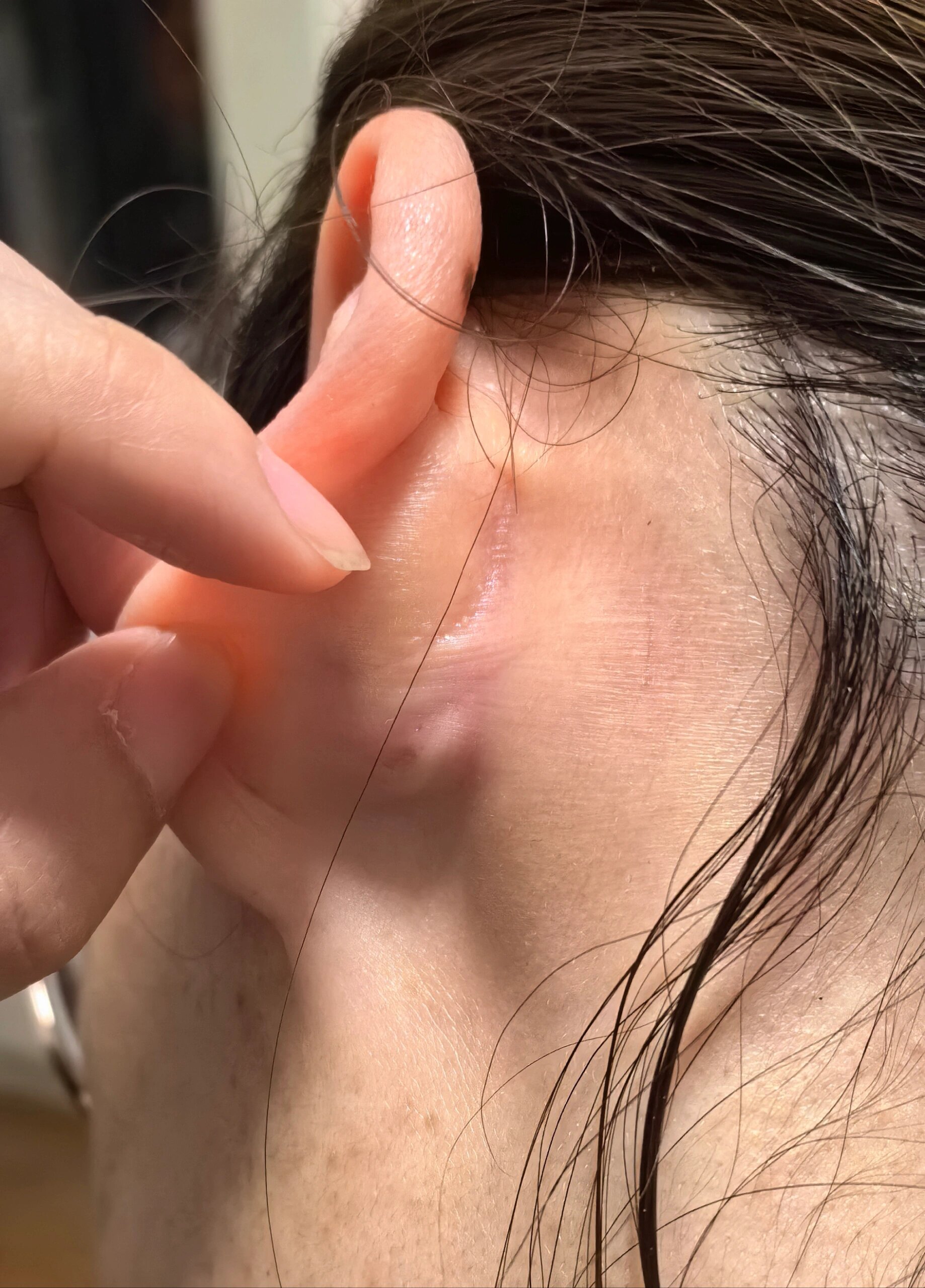 后来挂了耳鼻喉科,医生说不是淋巴结,是囊肿,吃点头孢,不好在去手术切