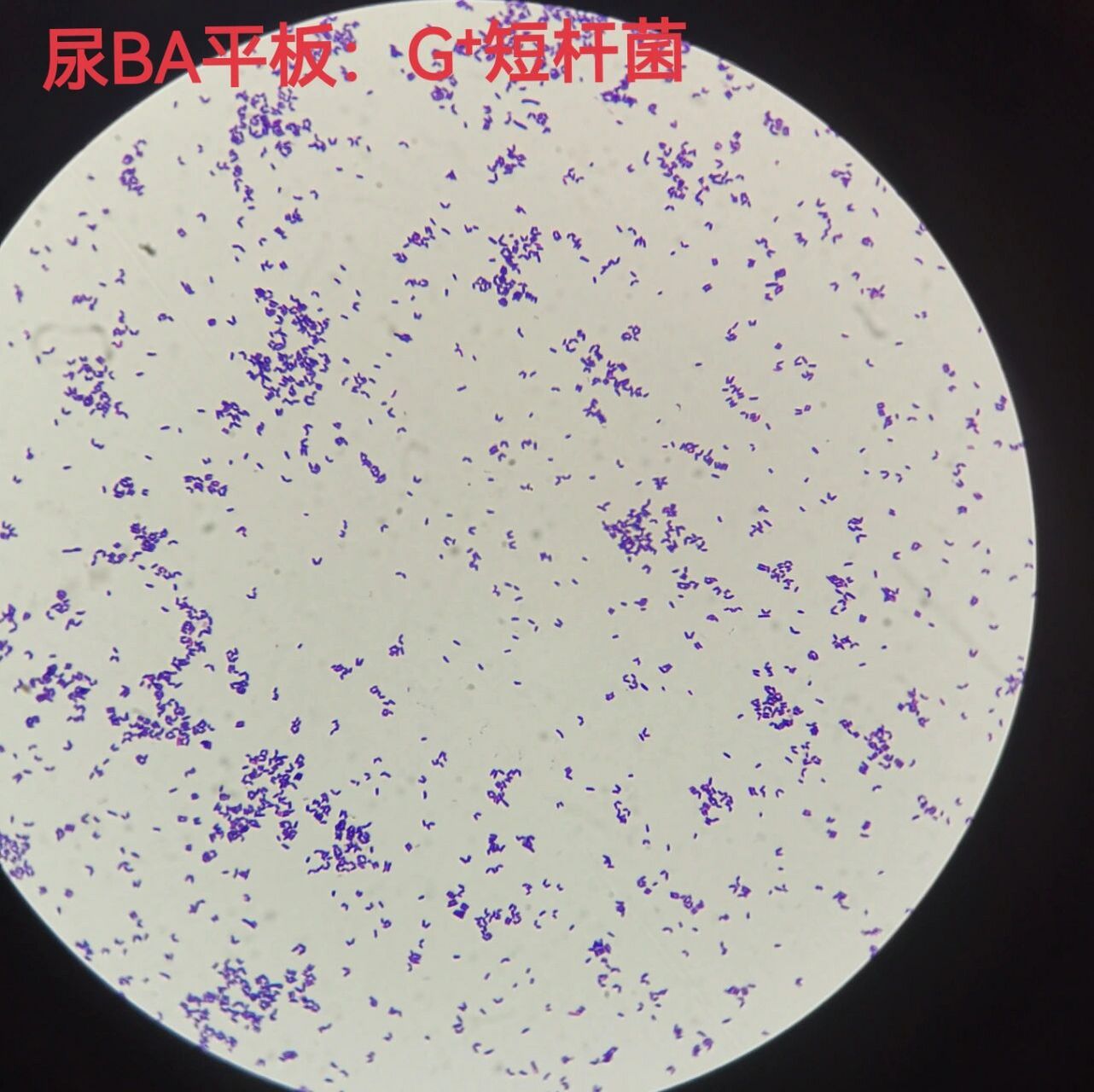 纹带棒状杆菌 尿标本革兰染色:阳性短杆菌