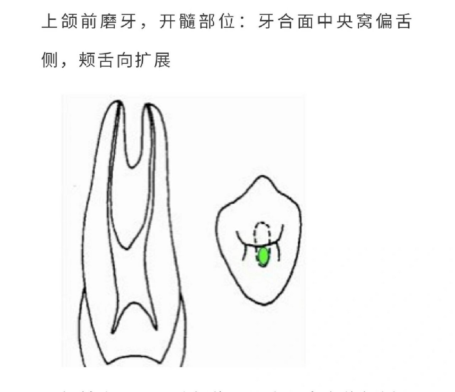 口腔开髓位置图图片