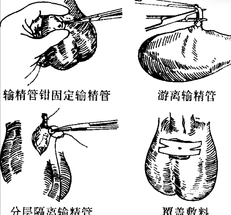 输精管分为三部分:睾丸部,精索部和盆部