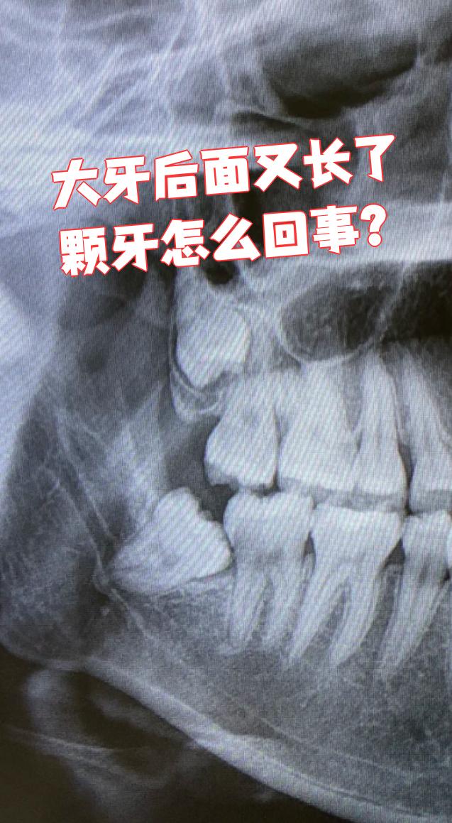 大牙后面又长出一颗牙,最常见的情况是长智齿或者多生牙