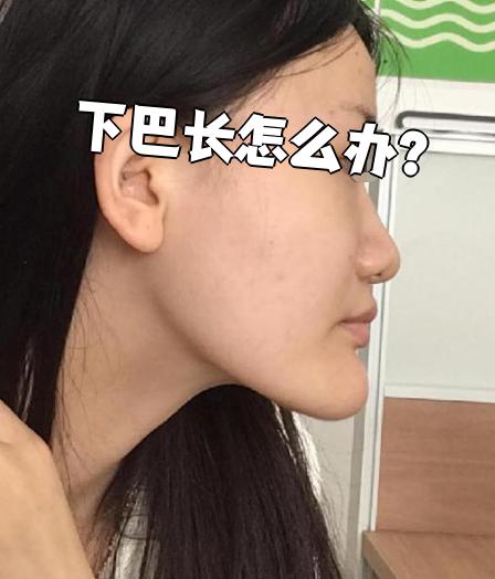 下巴长通常是指下颌偏长,常见原因包括遗传,发胖,牙齿咬合问题,受伤