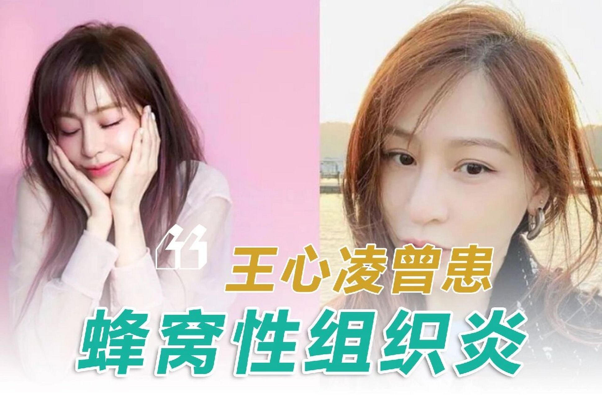 王心凌曾患蜂窝性组织炎 78157815近日,"甜心教主"王心凌的