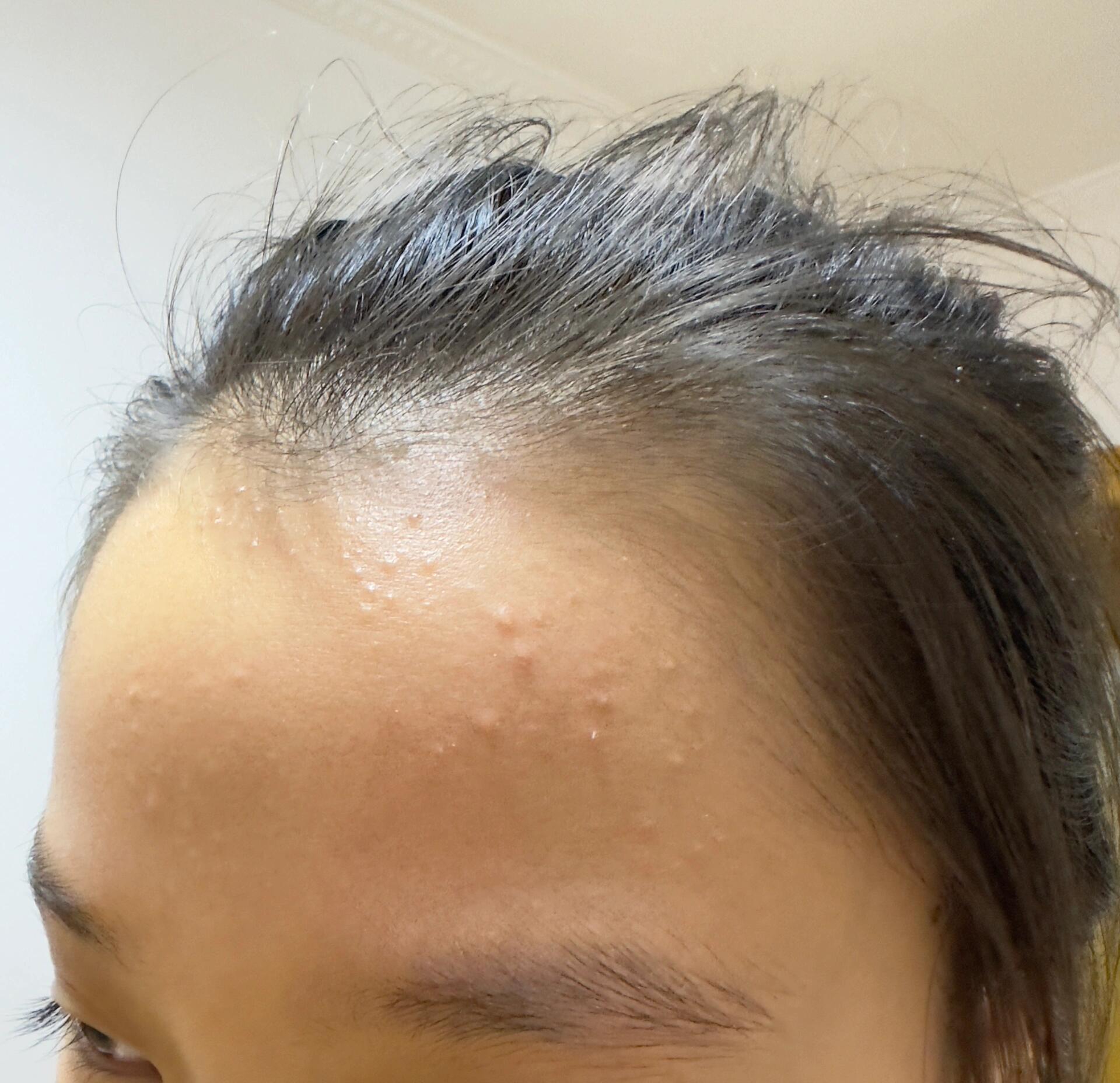 有懂的帮忙看一下 孩子额头上突然长了好多白色的小包包,也不疼也不痒