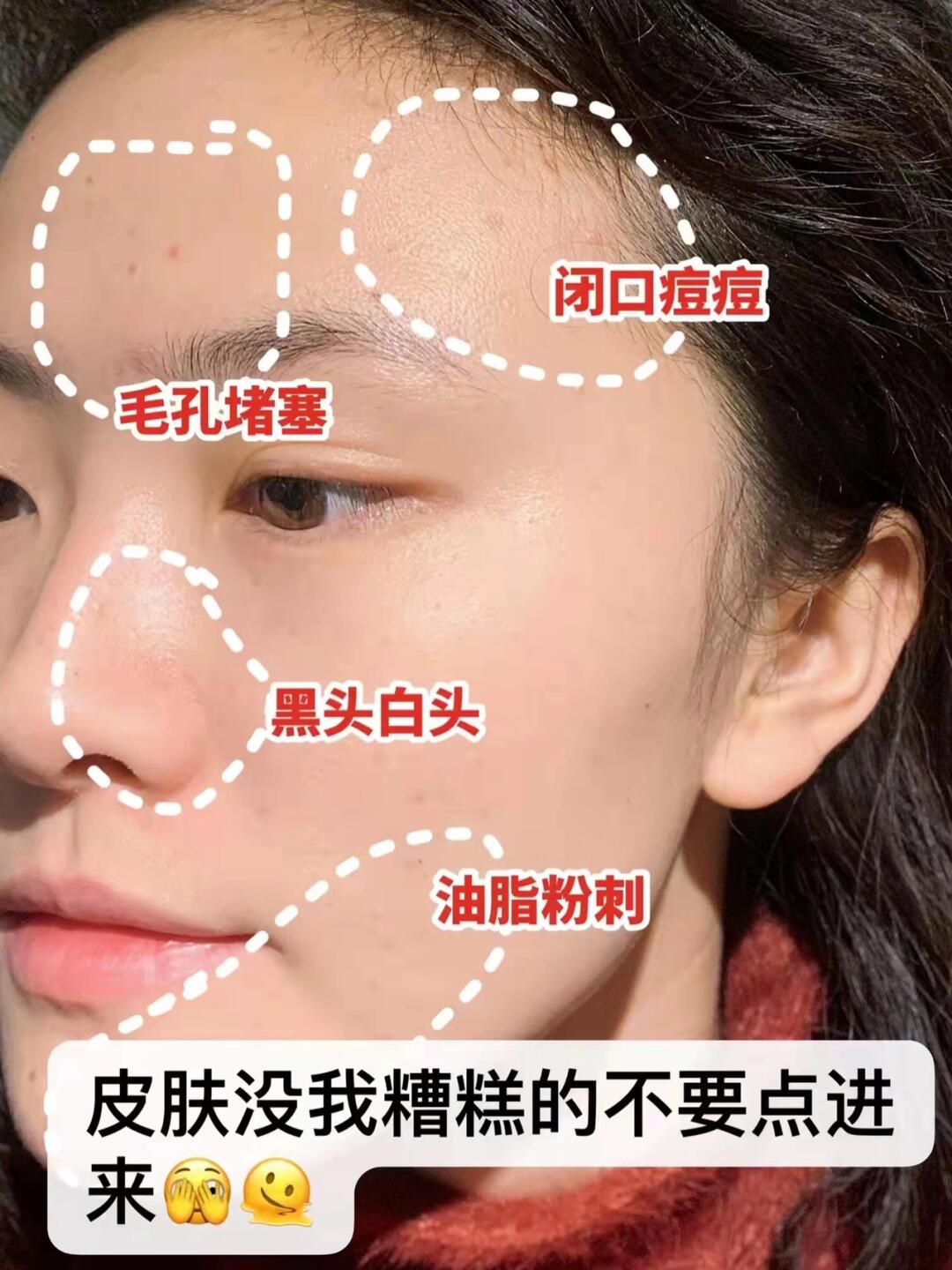 去闭口天菜!新手小白去闭口的正确方法!