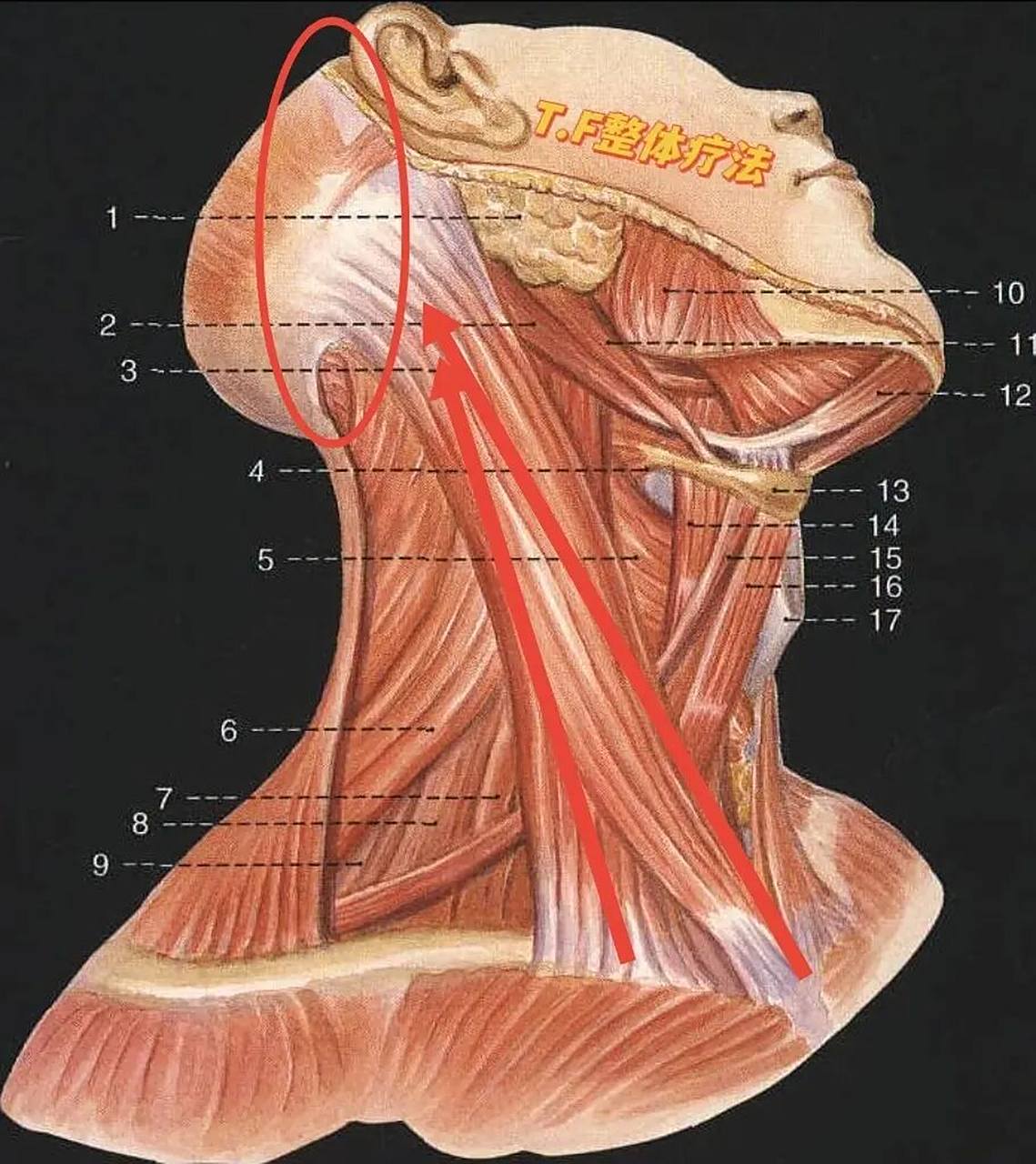 胸锁乳突肌,从前方的锁骨,胸骨角连接到颞骨乳突.