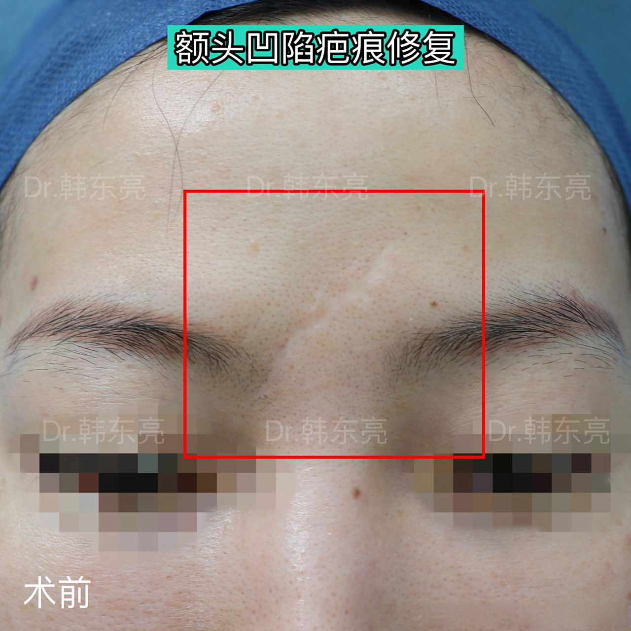 患者额头的凹陷疤痕,在外院做了多次激光都没有效果.