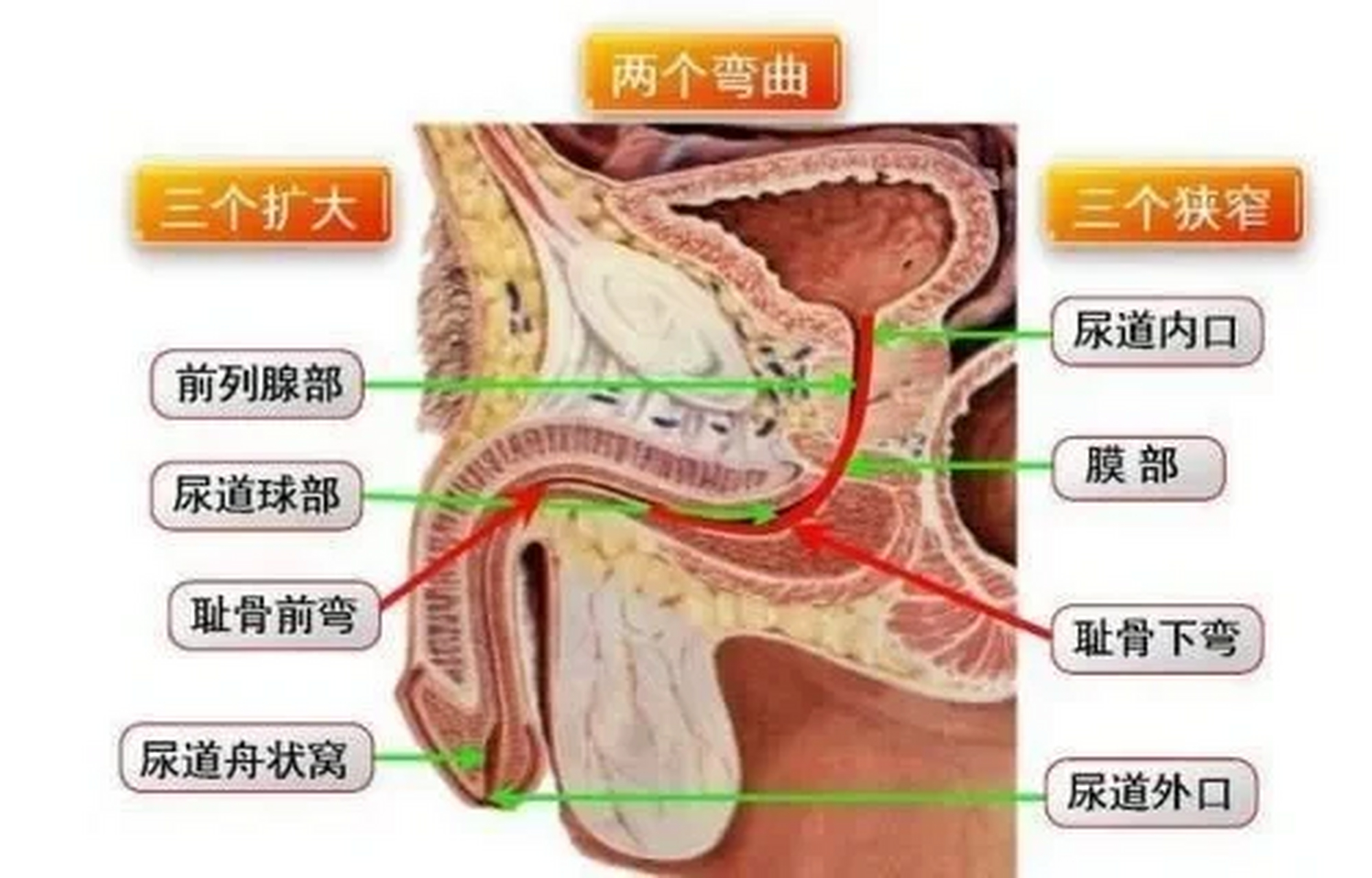 尿道的三个狭窄图片