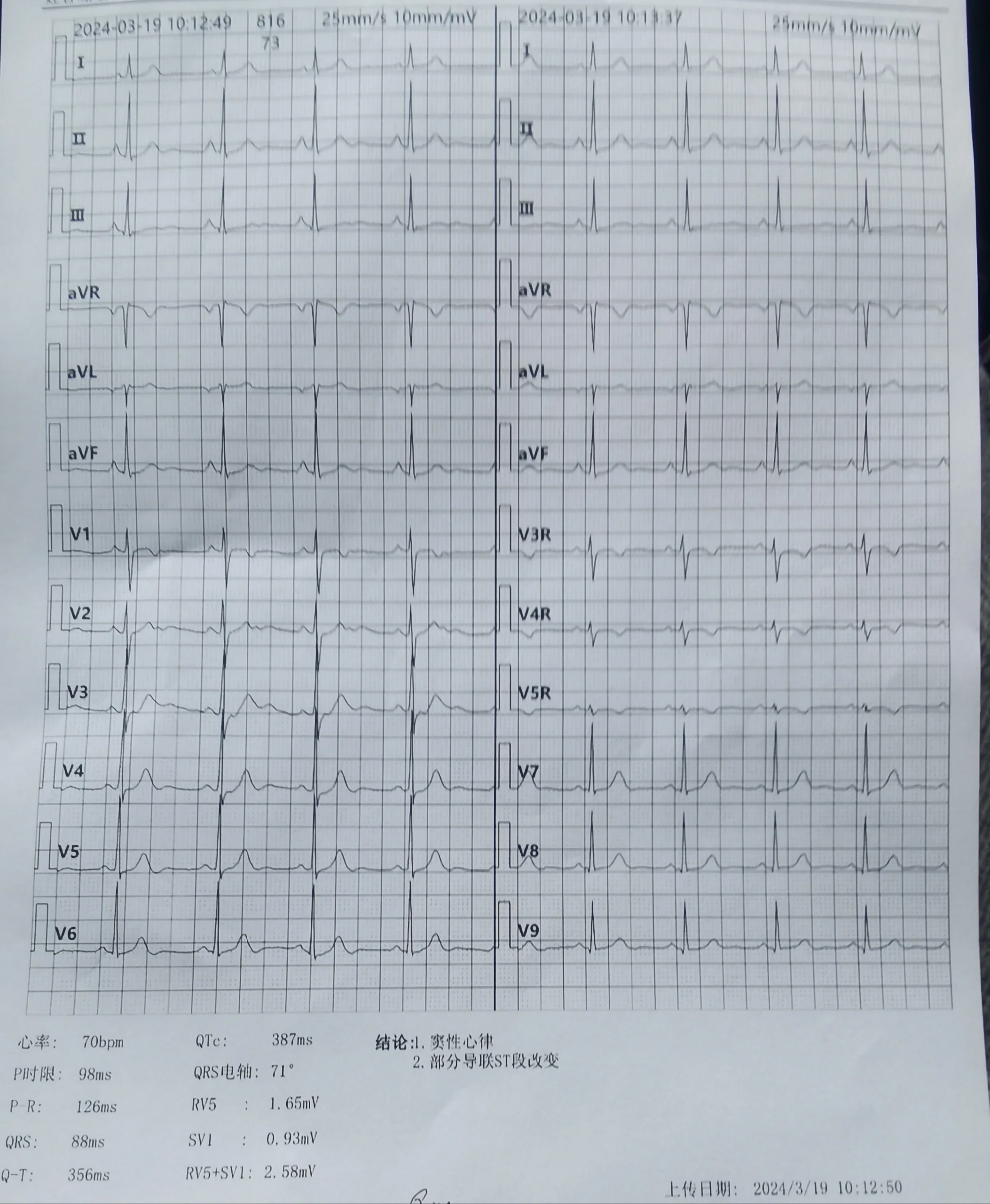 窦性心律 部分导联st段改变 上周开始心脏像漏跳一