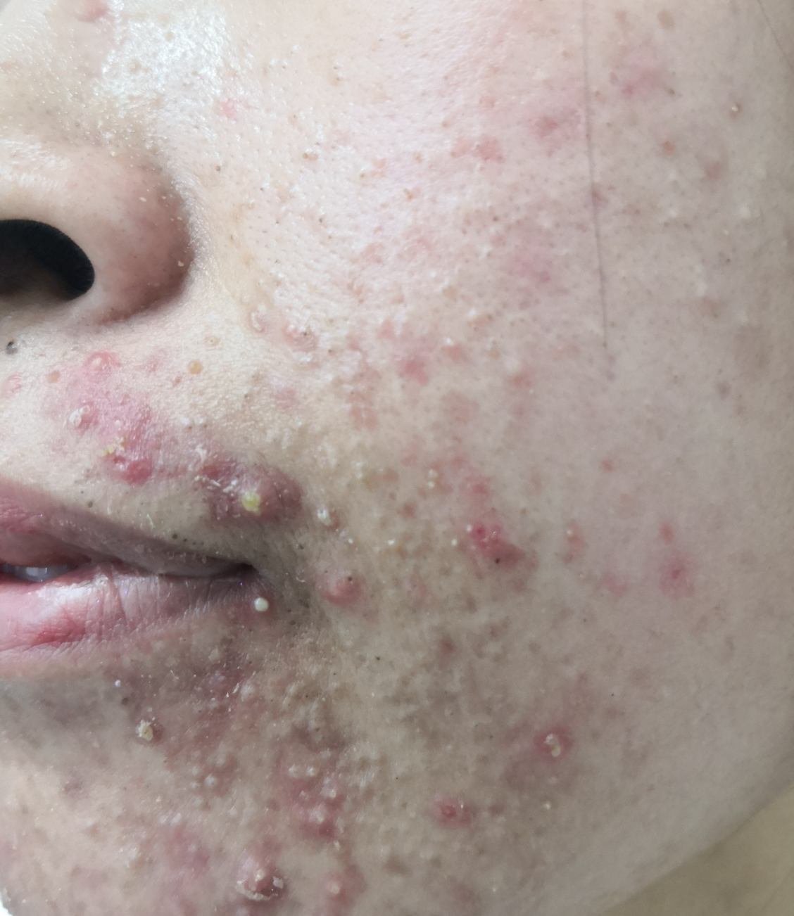 嘴巴周围长硬痘痘,常见原因有痤疮,过敏,毛囊炎,疖和单纯疱疹