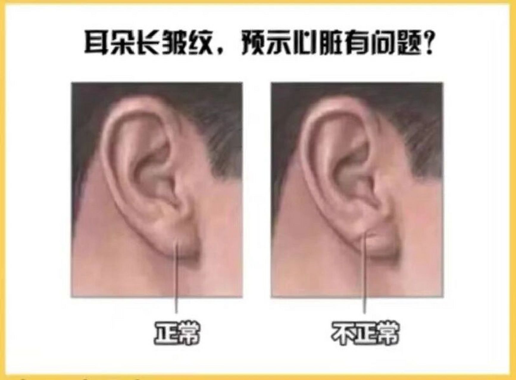 300名患有冠心病的人, 其中287人都有耳褶心征, 耳垂皱纹与动脉硬化