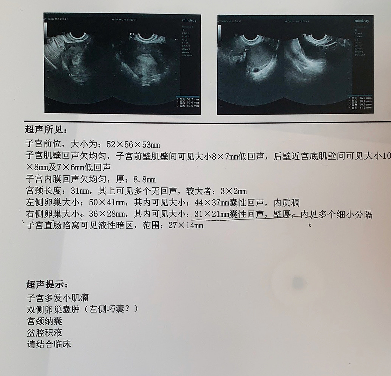 3cm,期间一直吃药调理以为会消失,但是完全没有忌口,10月29日复查