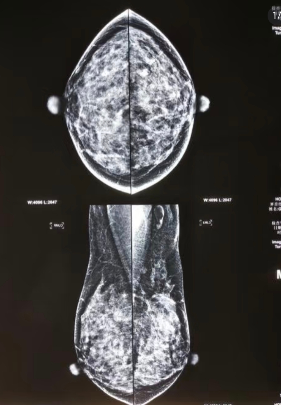 乳腺纤维瘤是因为乳腺小叶内的纤维细胞对雌激素过于敏感